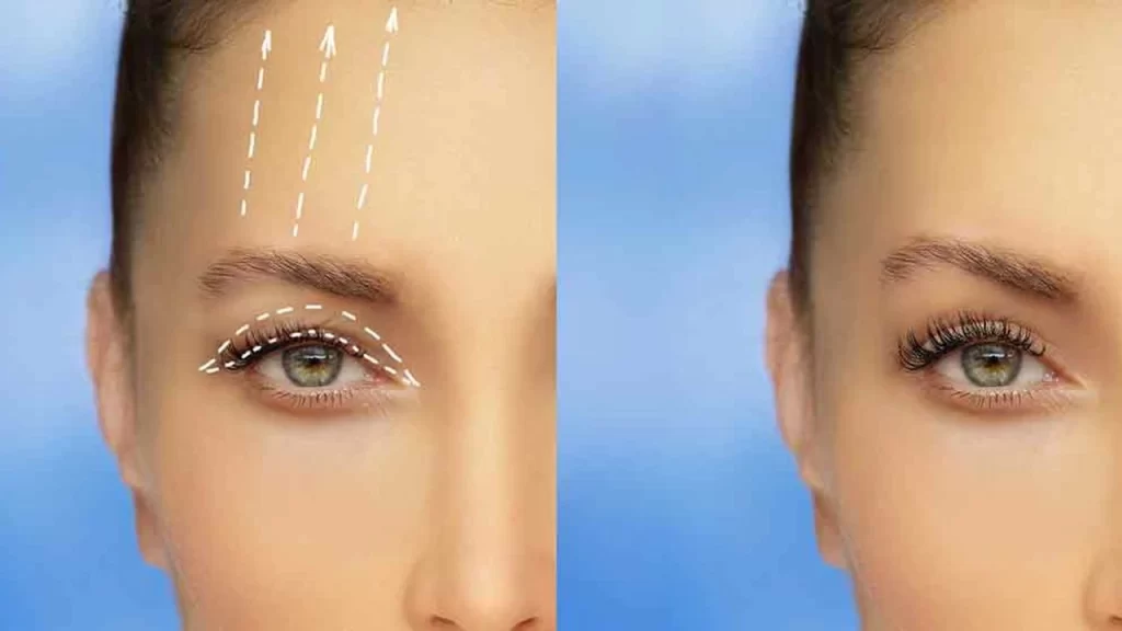 Devlet Hastanelerinde Göz Kapağı Estetiği Yapılıyor mu